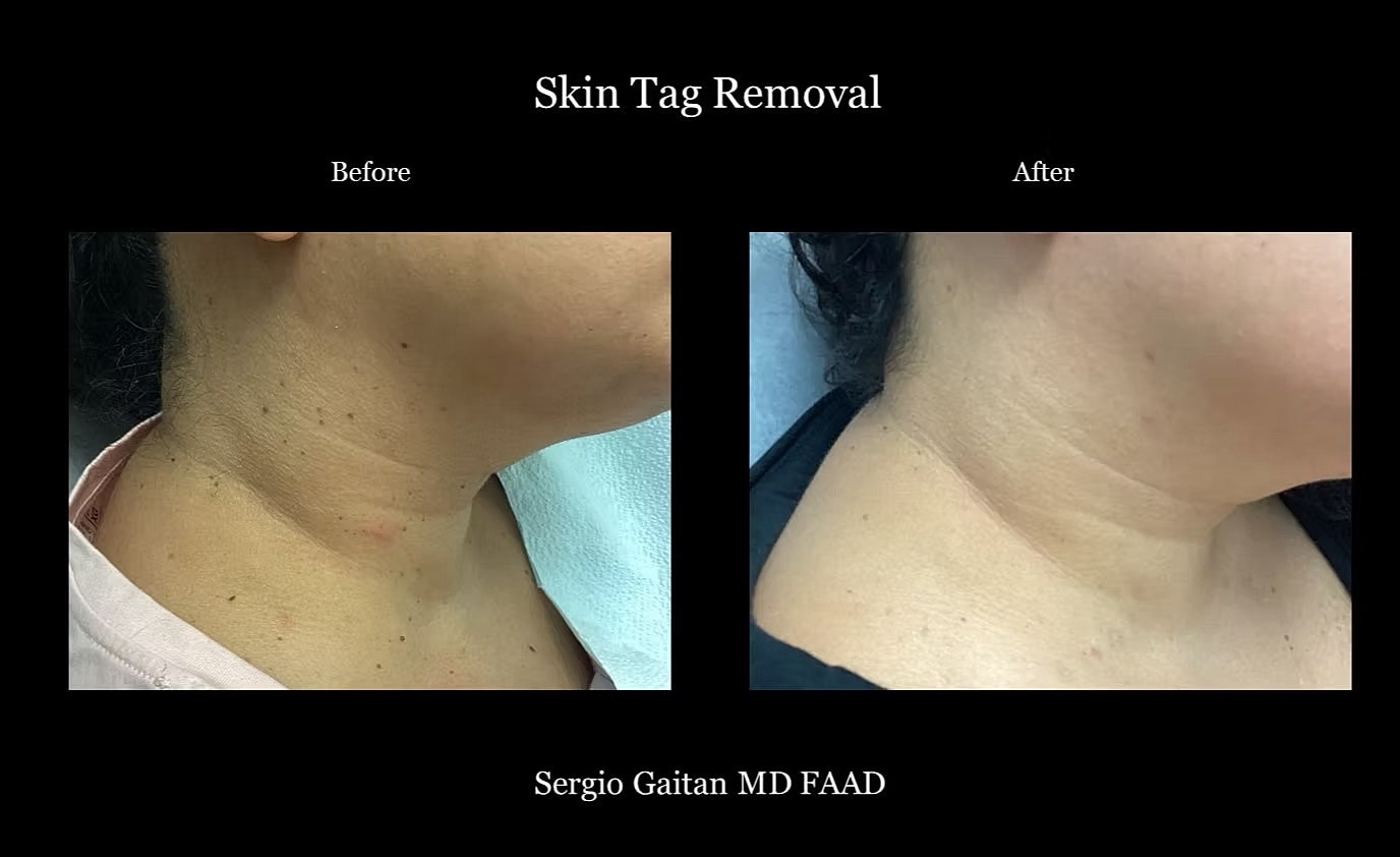 Before and after skin tag removal results