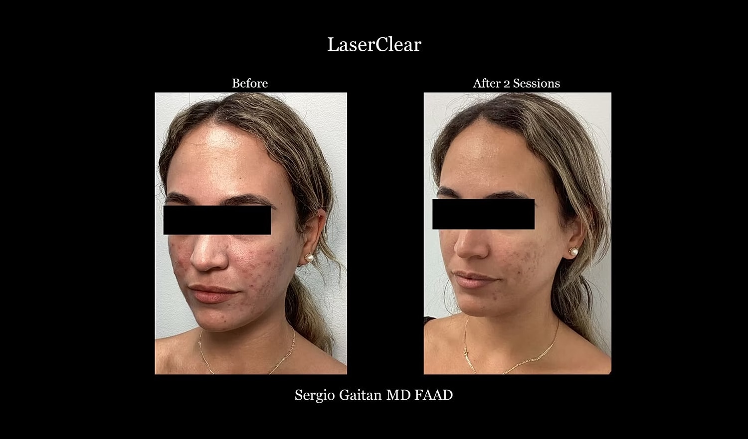Before and after LaserClear treatment results.