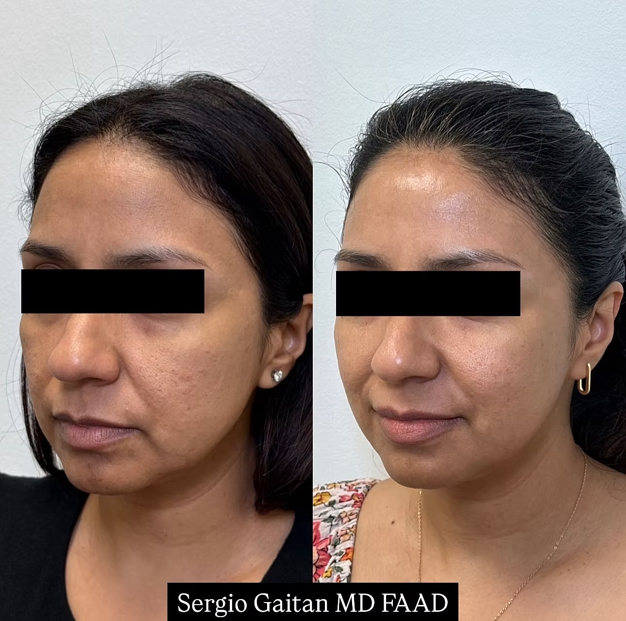 Before and after skin treatment comparison