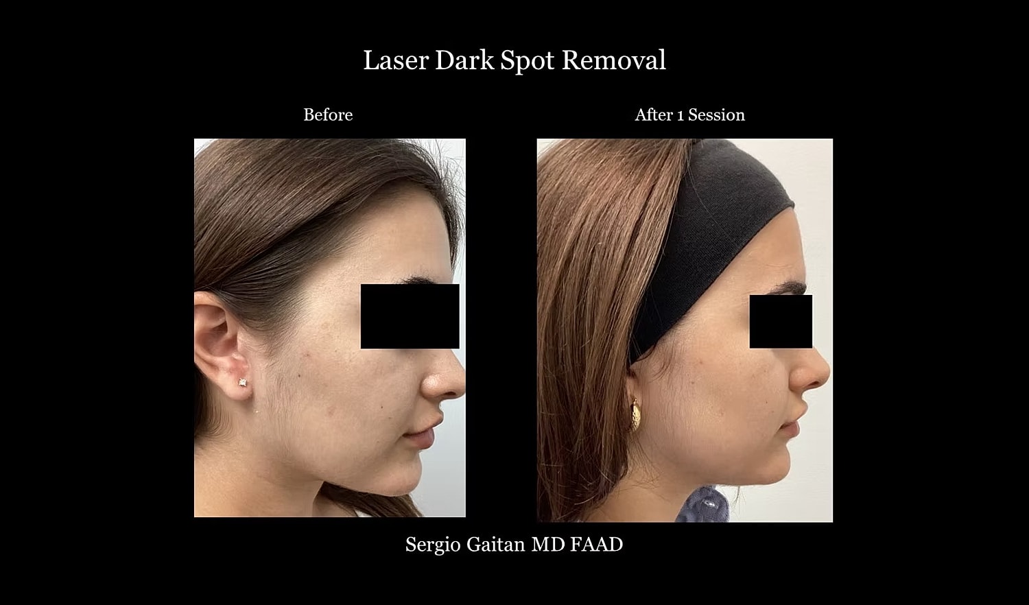 Laser dark spot removal before and after treatment