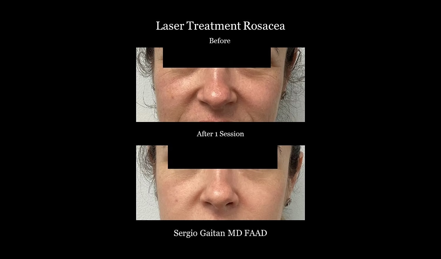 Before and after laser treatment for rosacea.