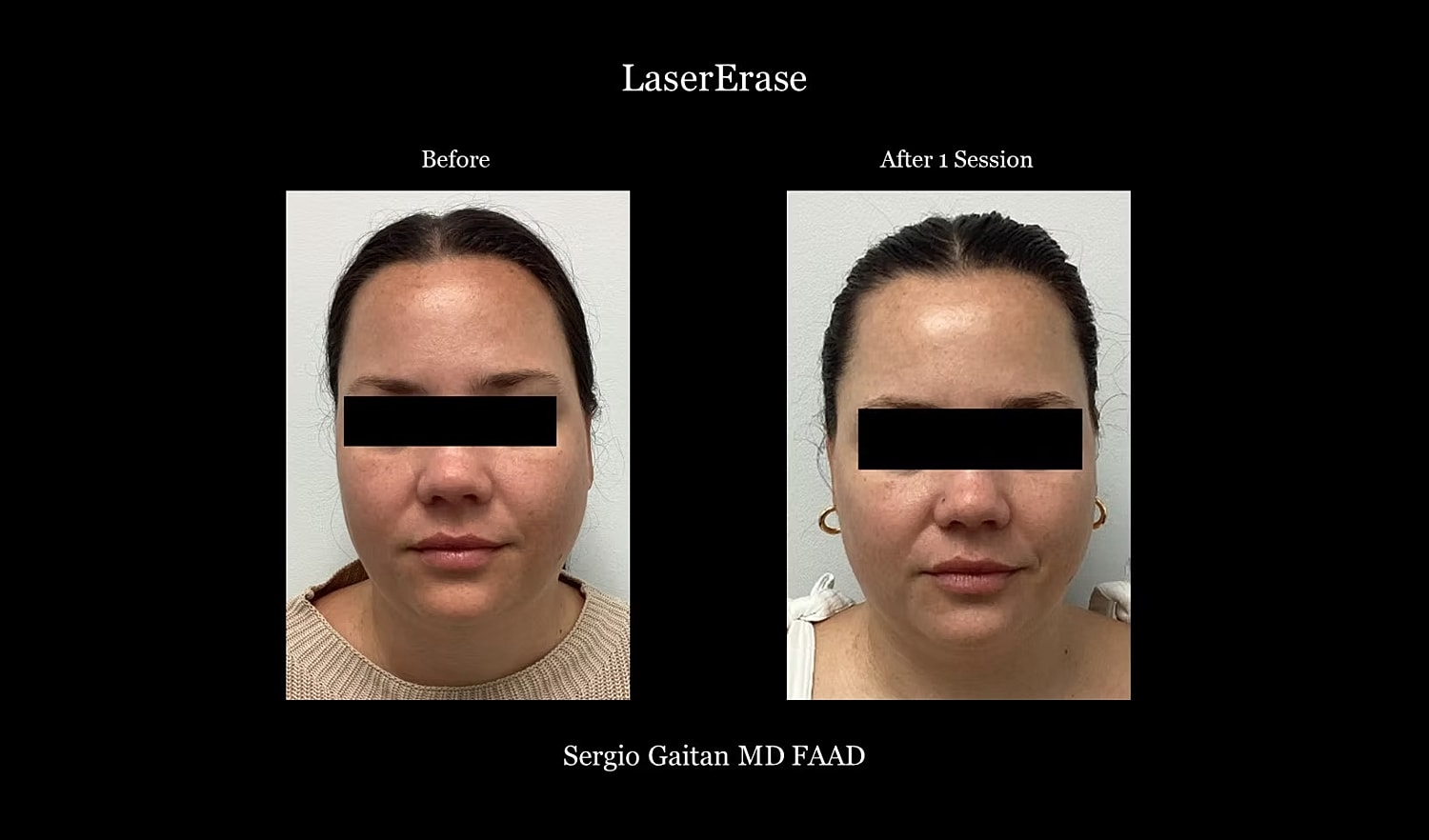 Laser treatment results: before and after comparison.