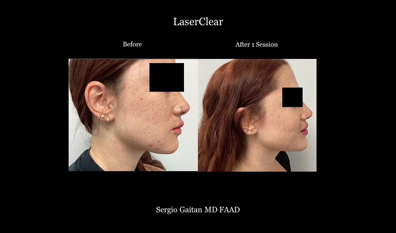 Before and after laser skin treatment comparison