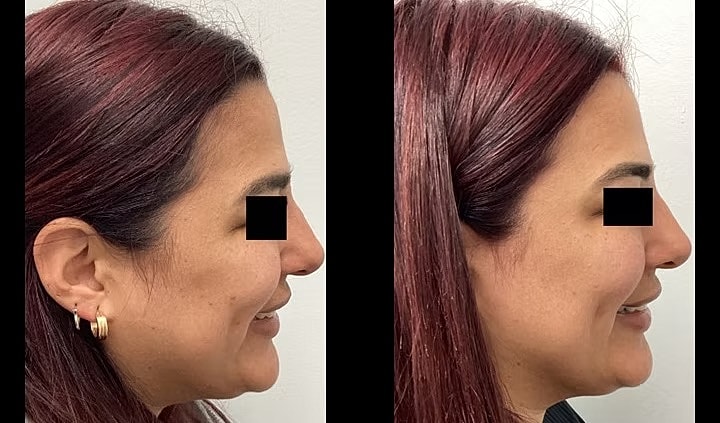 Profile comparison before and after treatment.