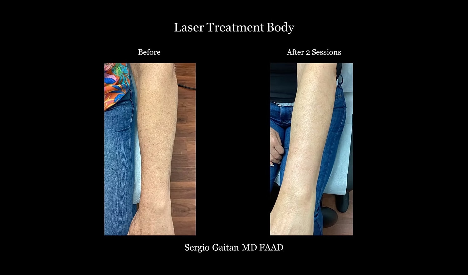 Before and after laser treatment for skin.