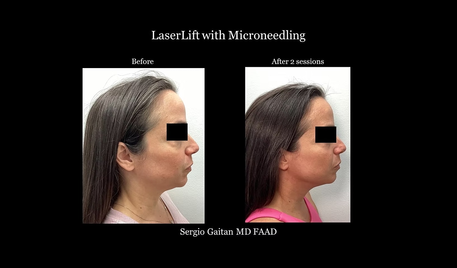 Before and after LaserLift with microneedling.