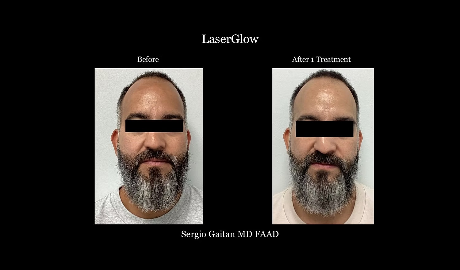 Before and after laser treatment images comparison.
