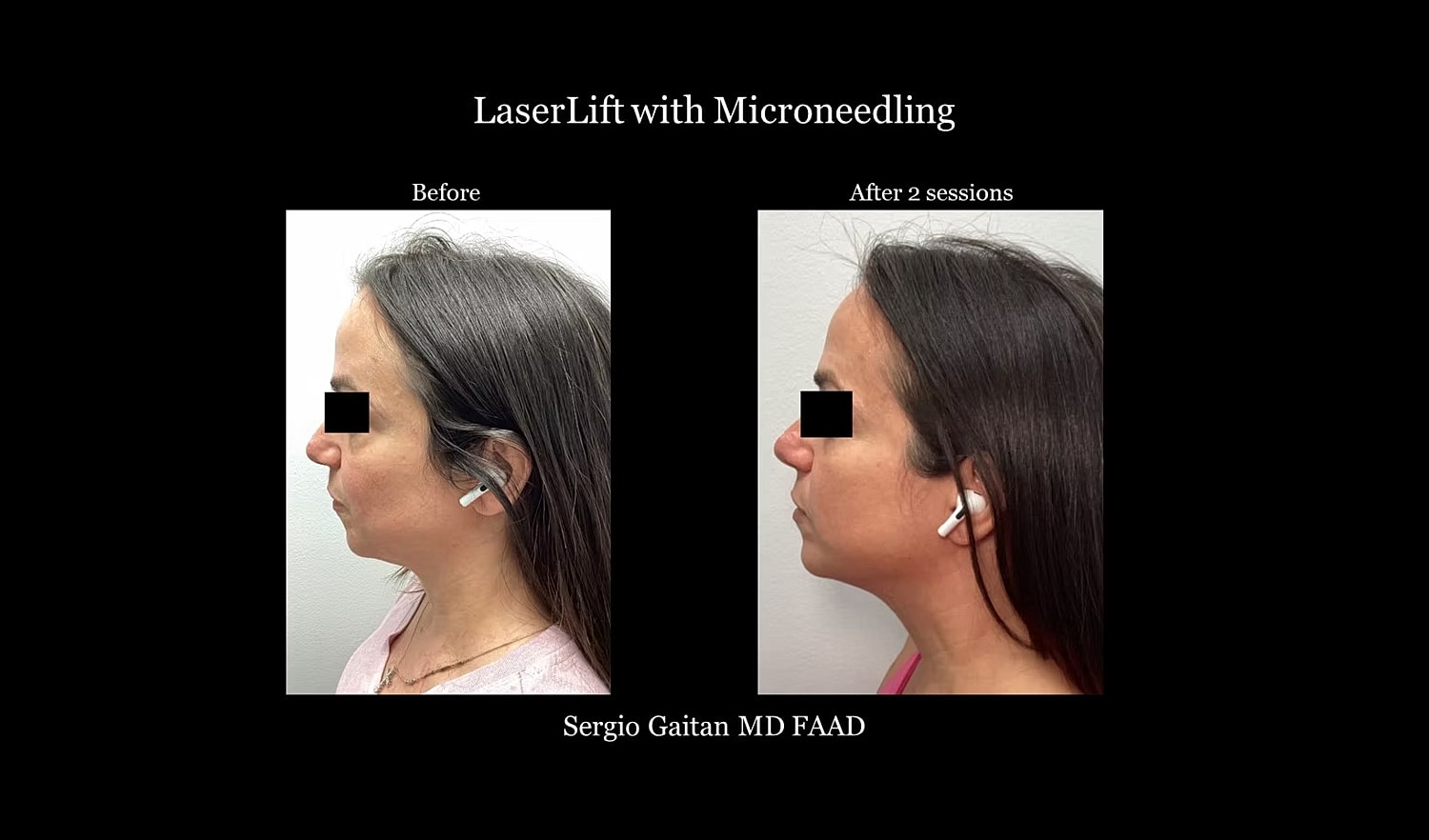 LaserLift results before and after microneedling.
