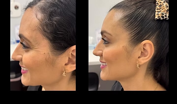 Before and after profile side view of woman