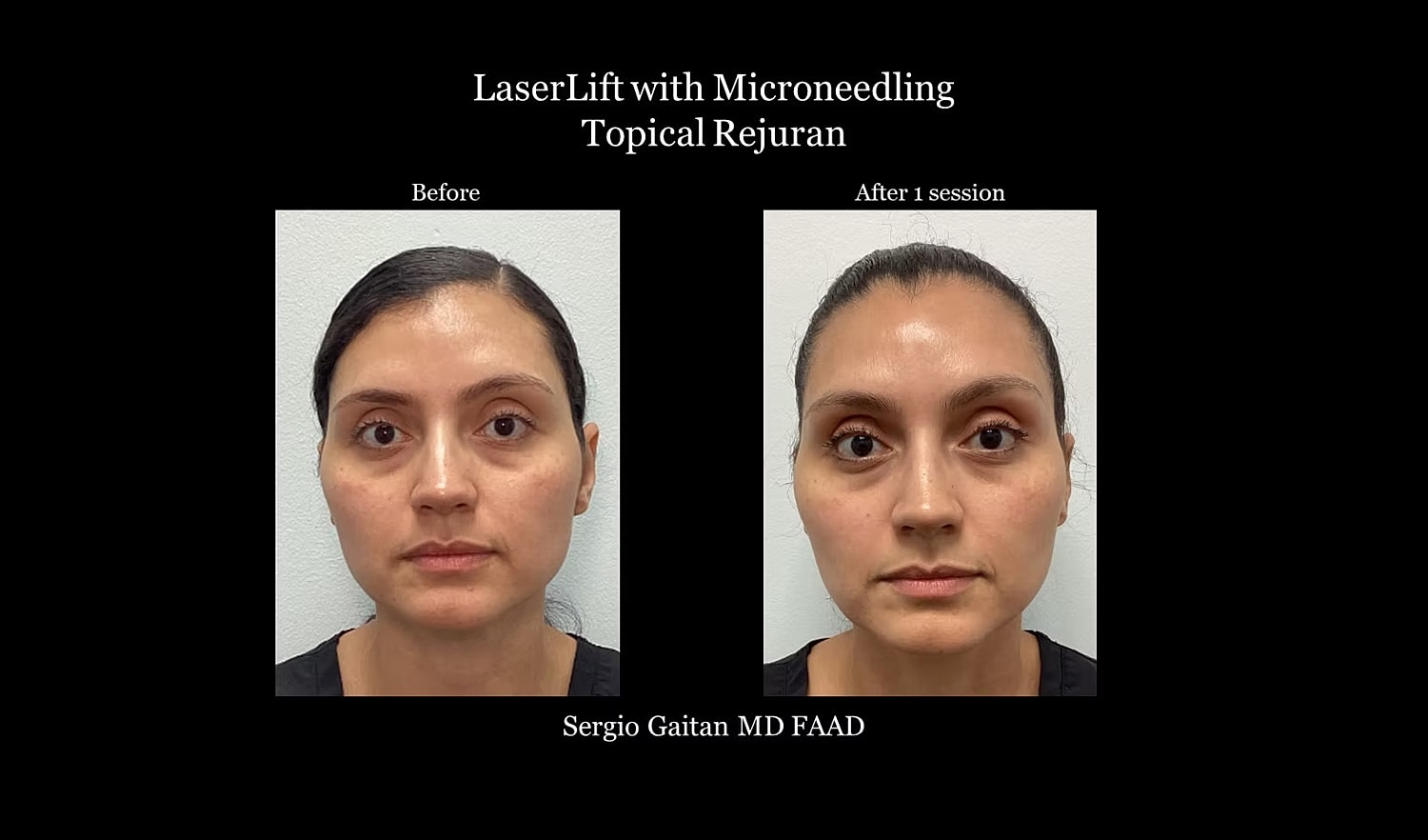 Before and after LaserLift microneedling treatment.