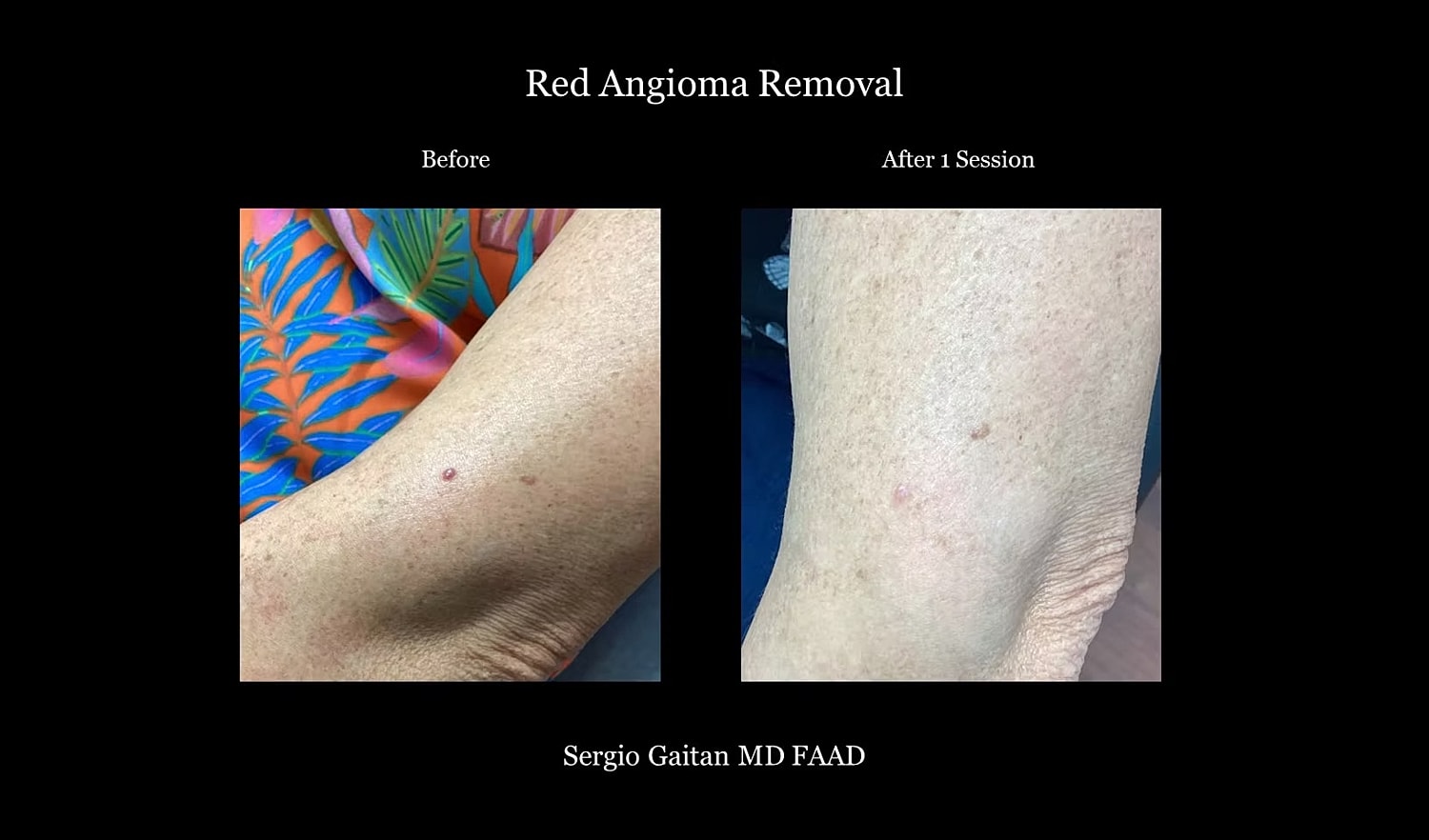 Red angiom removal before and after treatment.