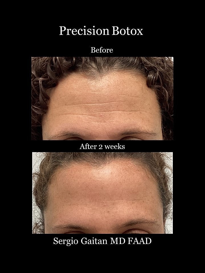 Botox results before and after two weeks.