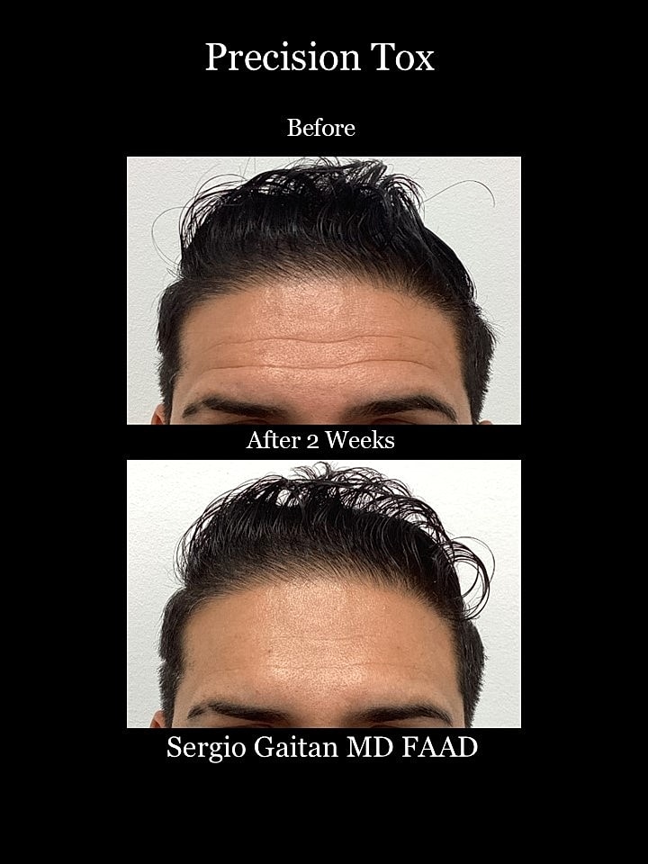 Before and after results of Precision Tox treatment.