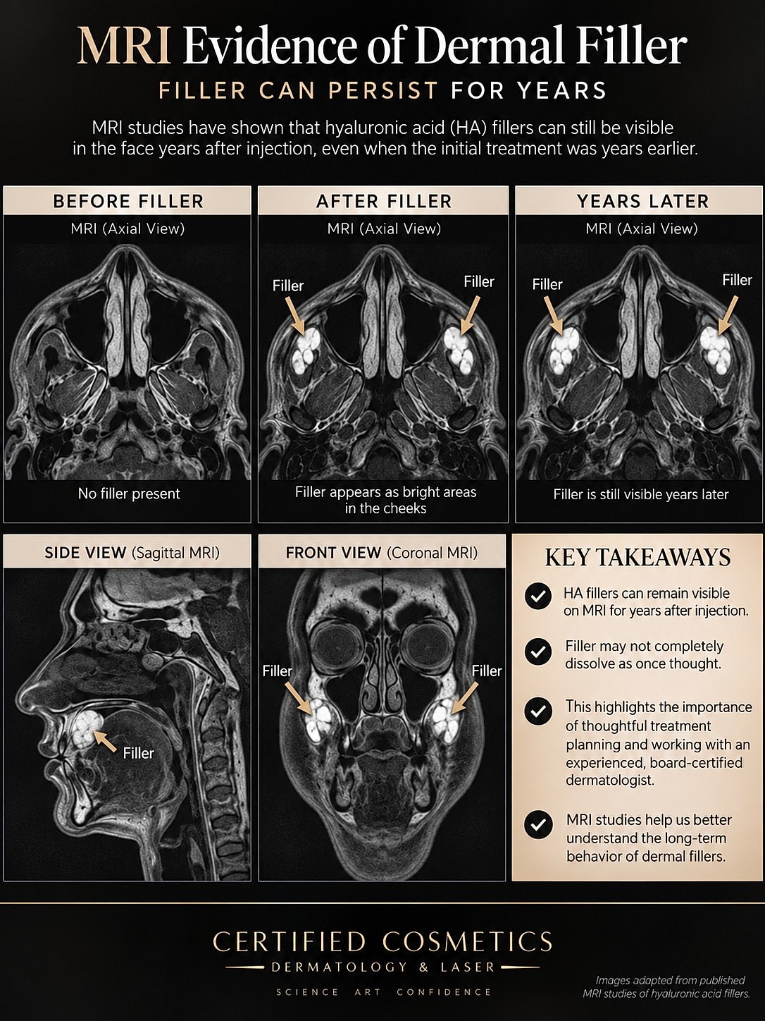 MRI images showing persistence of dermal filler.