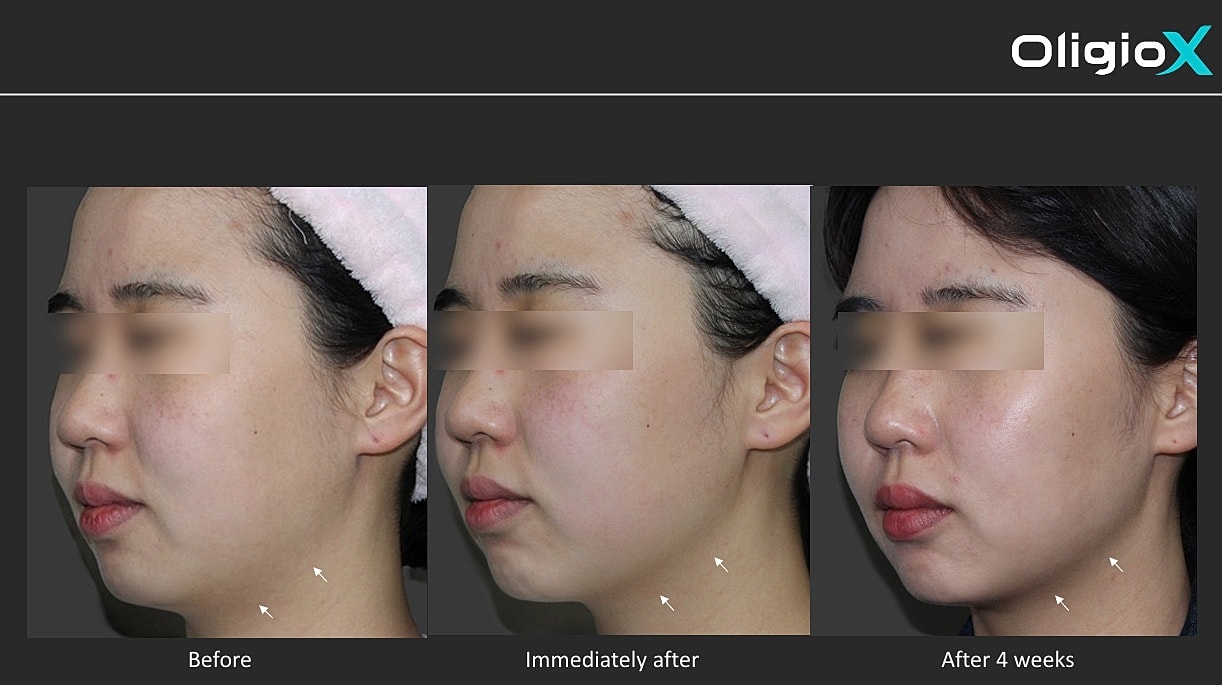 Facial transformation: before, immediately after, and four weeks.