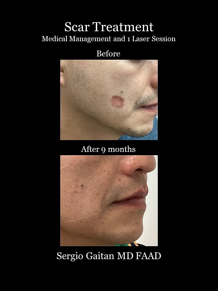 Scar Treatment Before & After