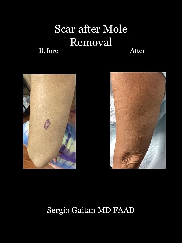 Surgical Dermatology Before & After