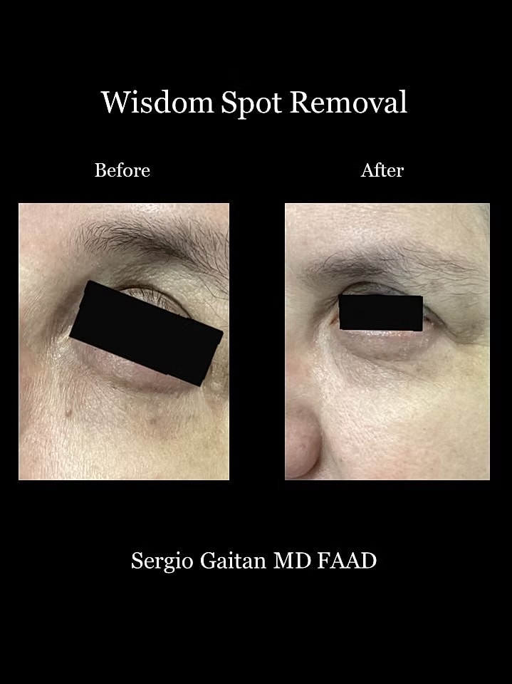 Mole and Dark Spot Removal  Before & After