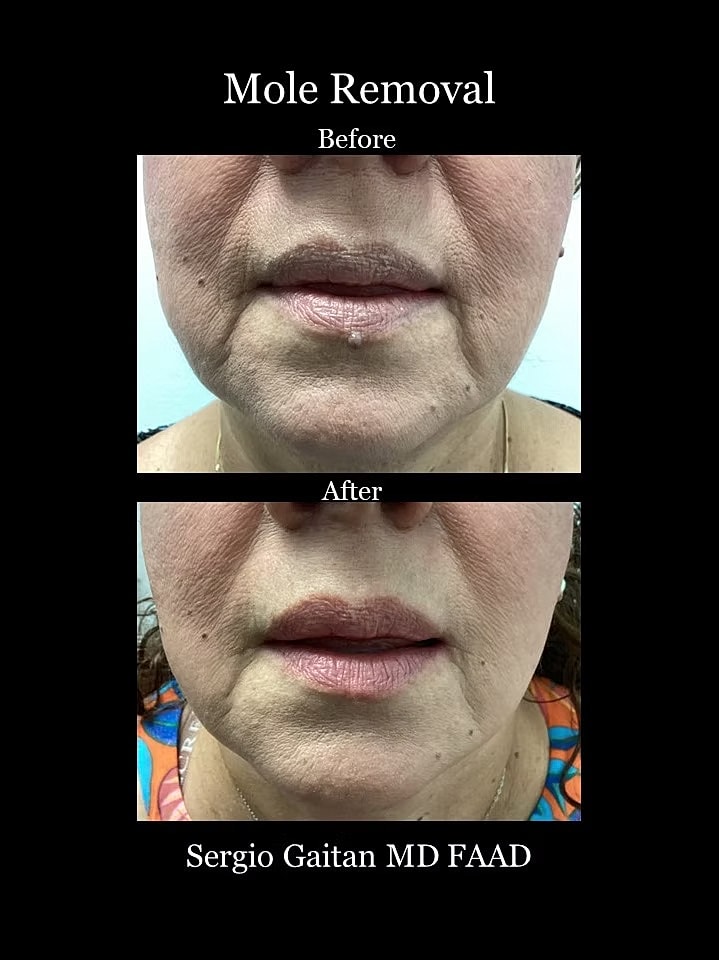 Mole and Dark Spot Removal  Before & After
