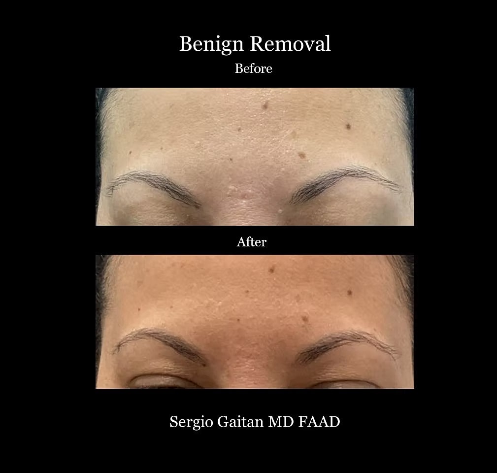 Mole and Dark Spot Removal  Before & After