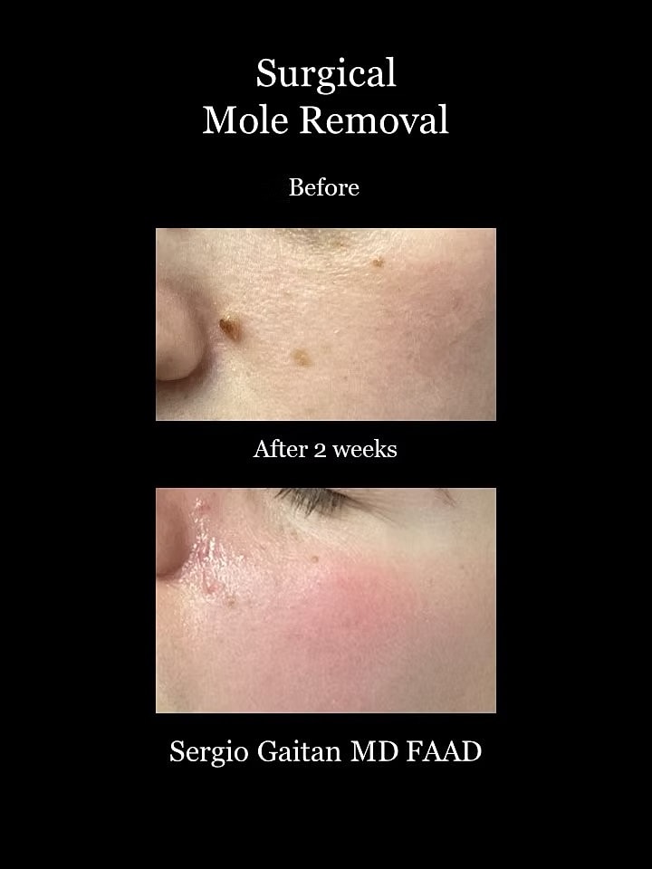 Mole and Dark Spot Removal  Before & After