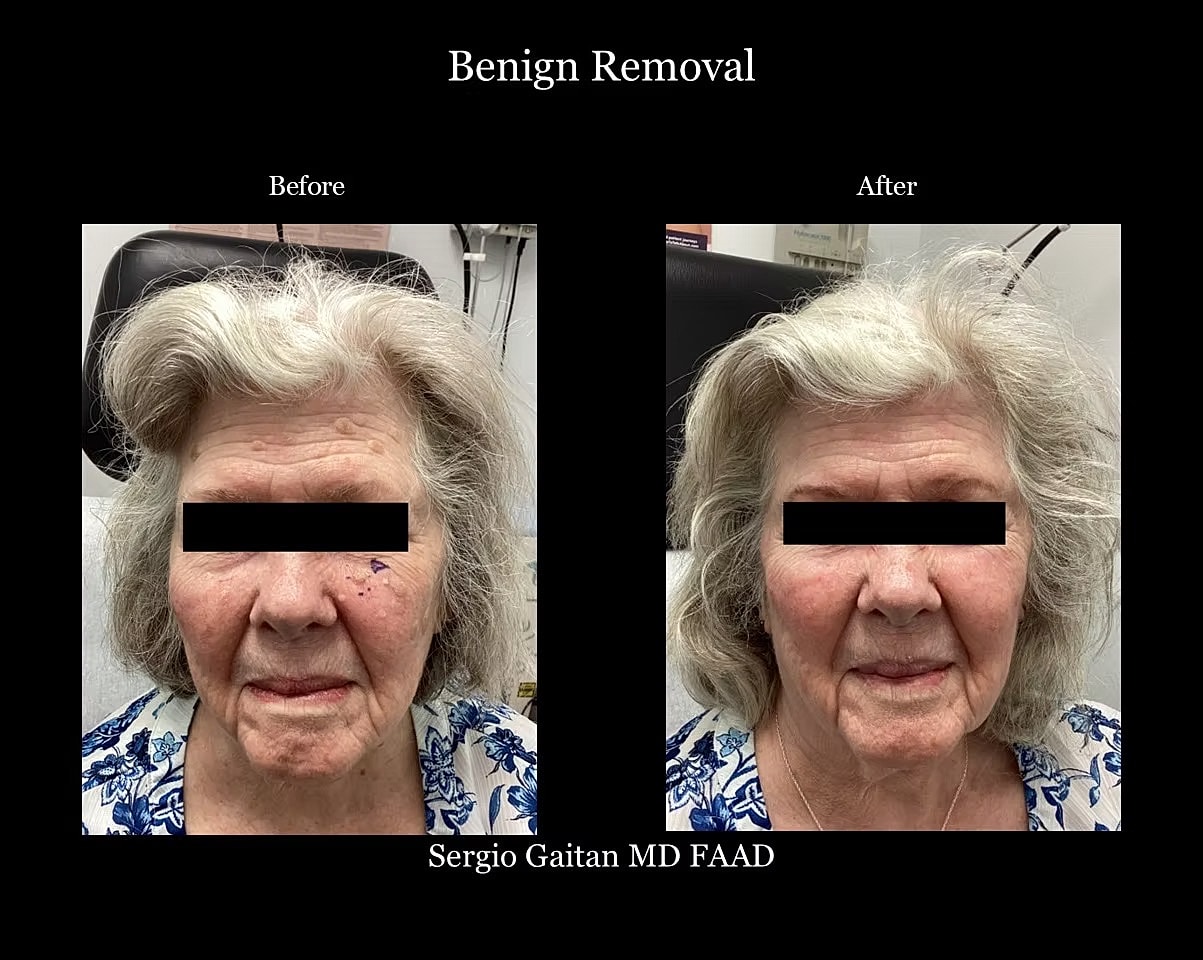 Mole and Dark Spot Removal  Before & After