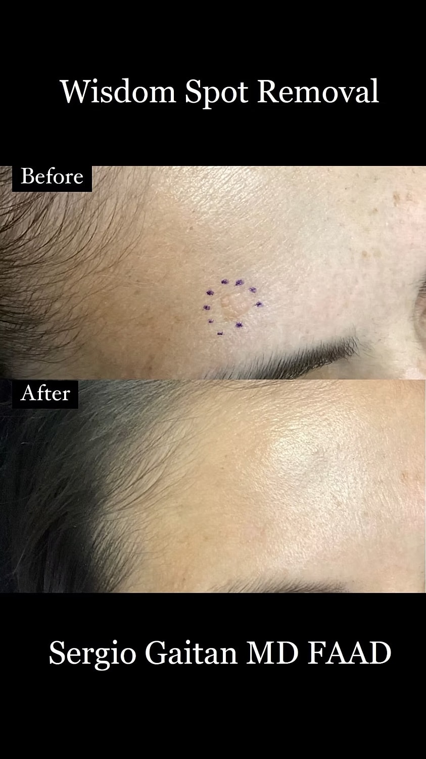 Mole and Dark Spot Removal  Before & After