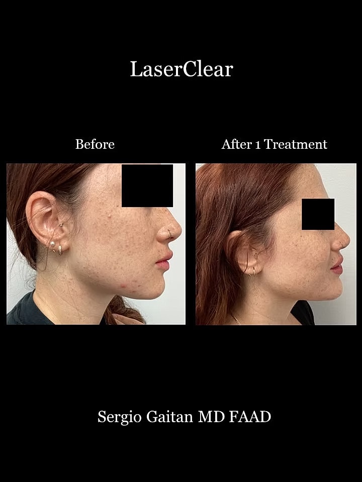 Acne Before & After