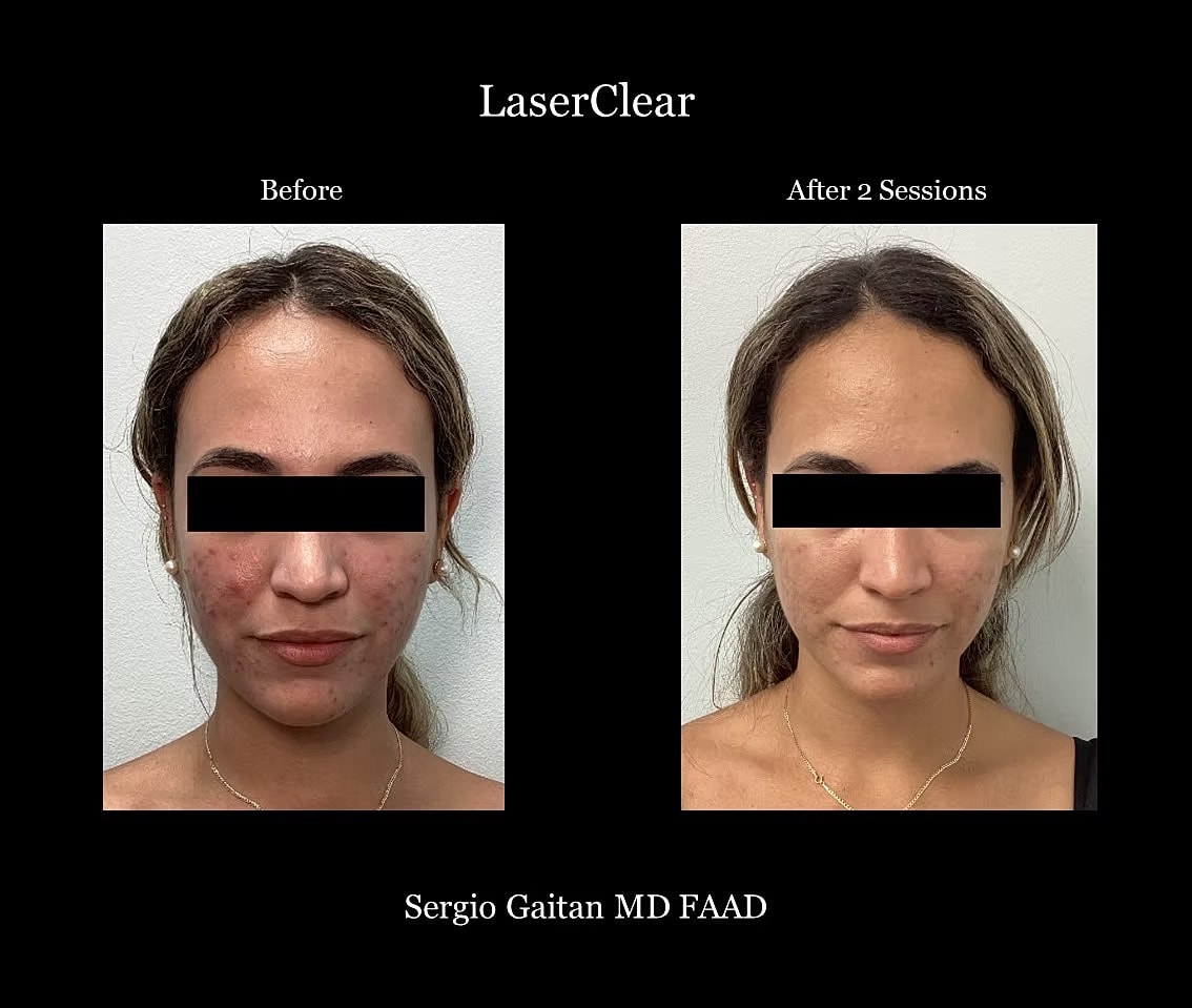 Acne Before & After