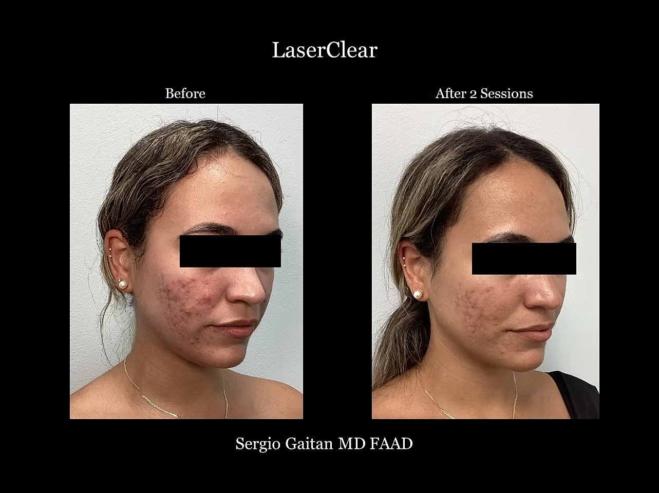 Acne Before & After