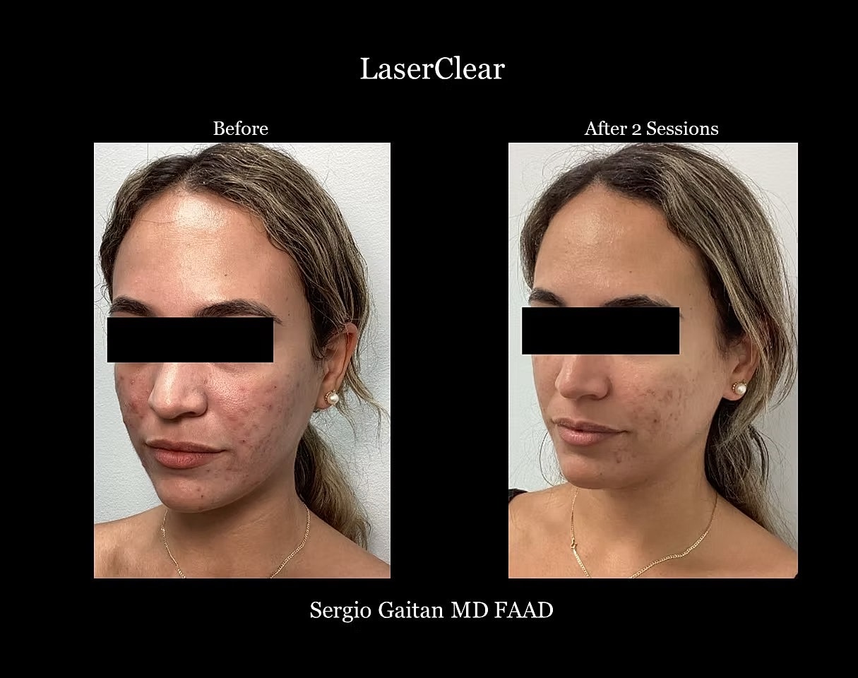 Acne Before & After