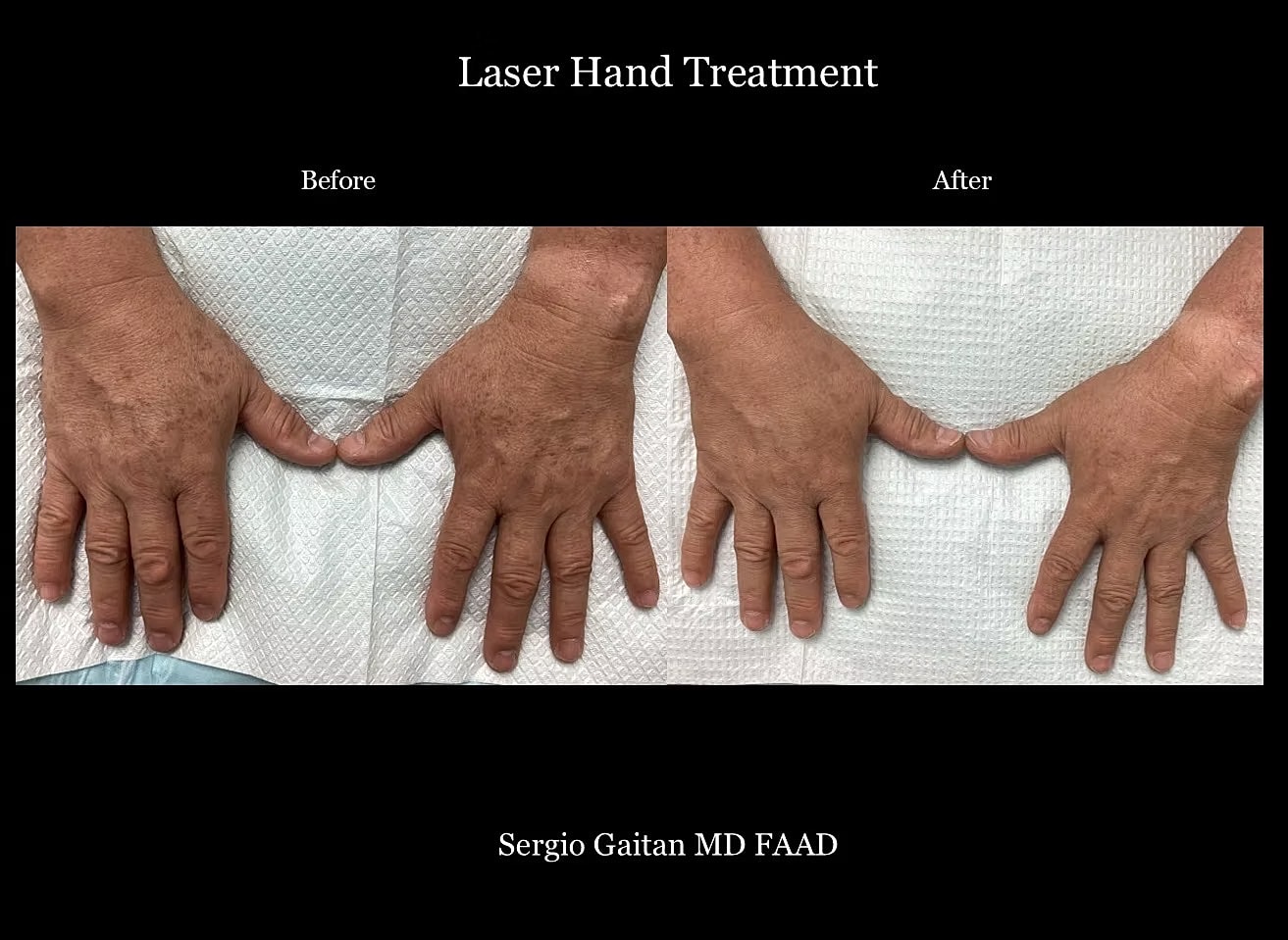 Laser Dark Spot Removal Hands Before & After