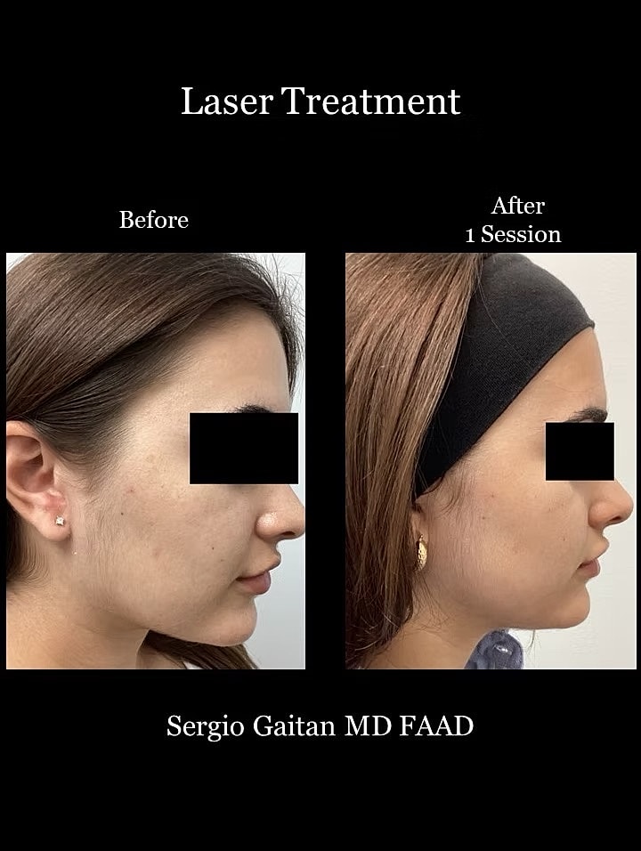 Laser Dark Spot Removal Face Before & After