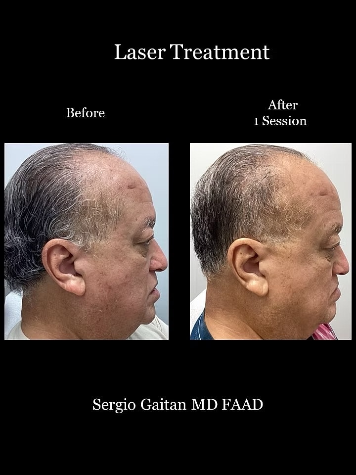 Laser Dark Spot Removal Face Before & After