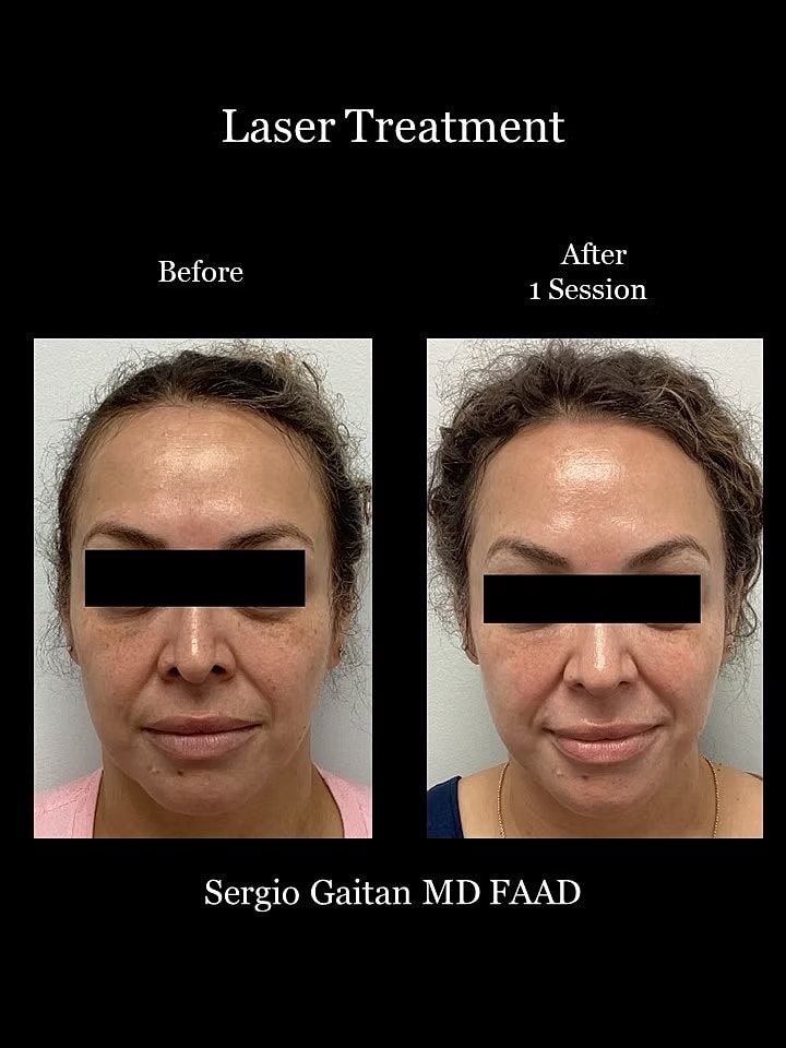 Brightening Laser Facial Before & After