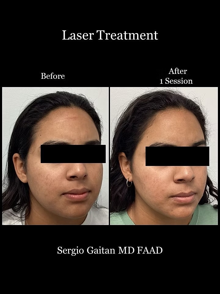 Brightening Laser Facial Before & After