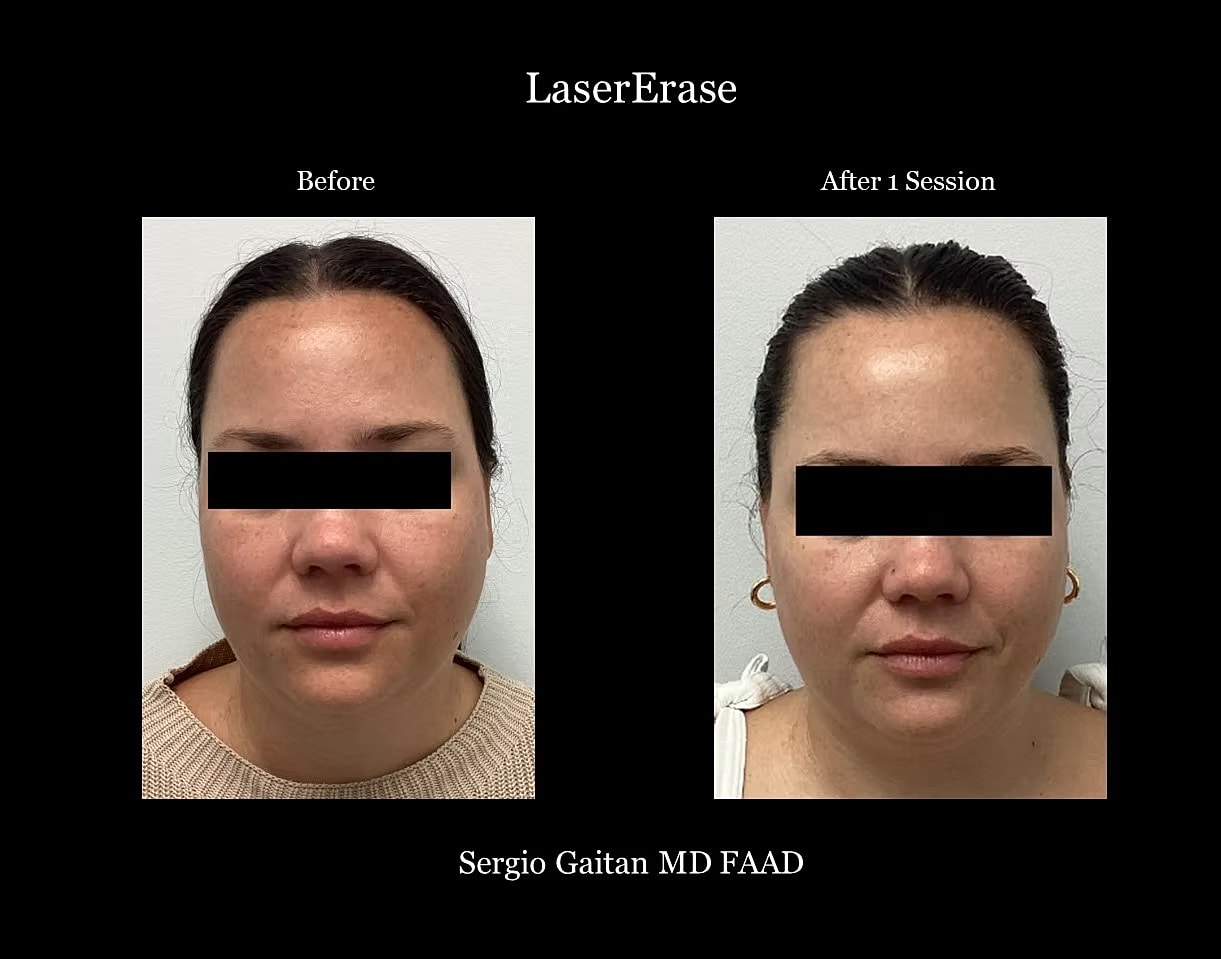 Lasererase Before & After