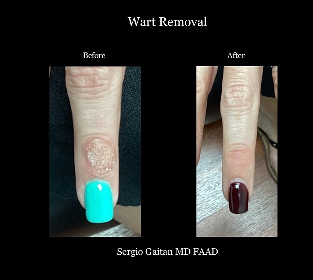 Wart Removal Before & After