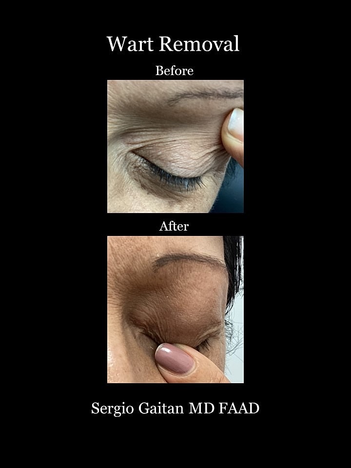 Wart Removal Before & After