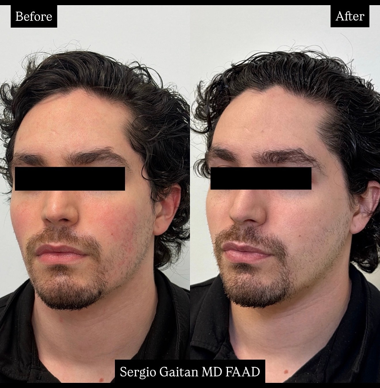 Rosacea Laser Treatment Before & After