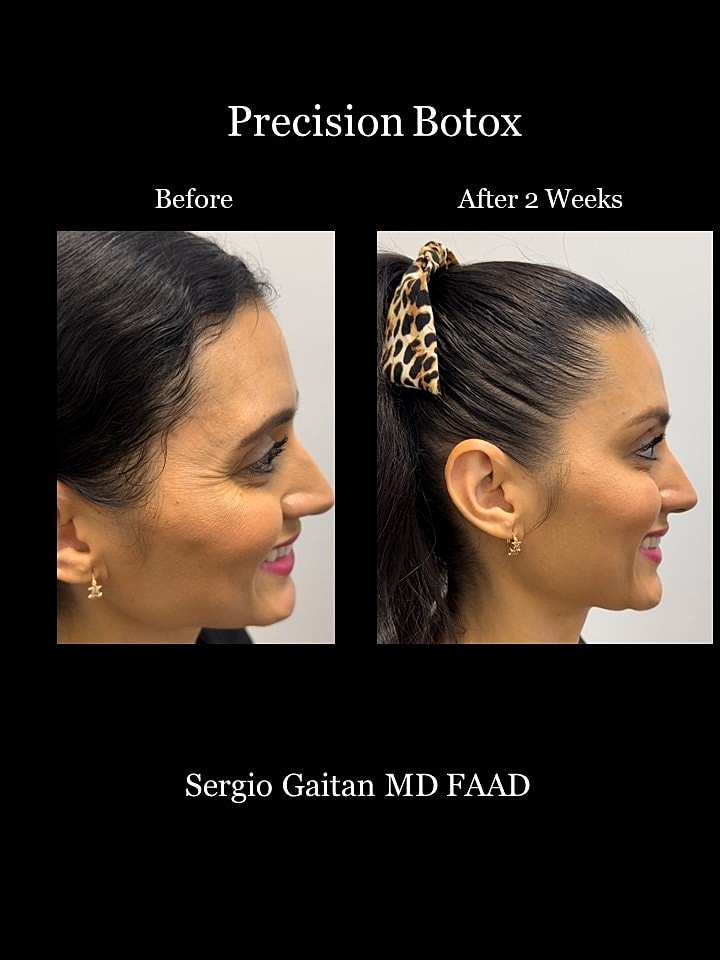 Botox Before & After