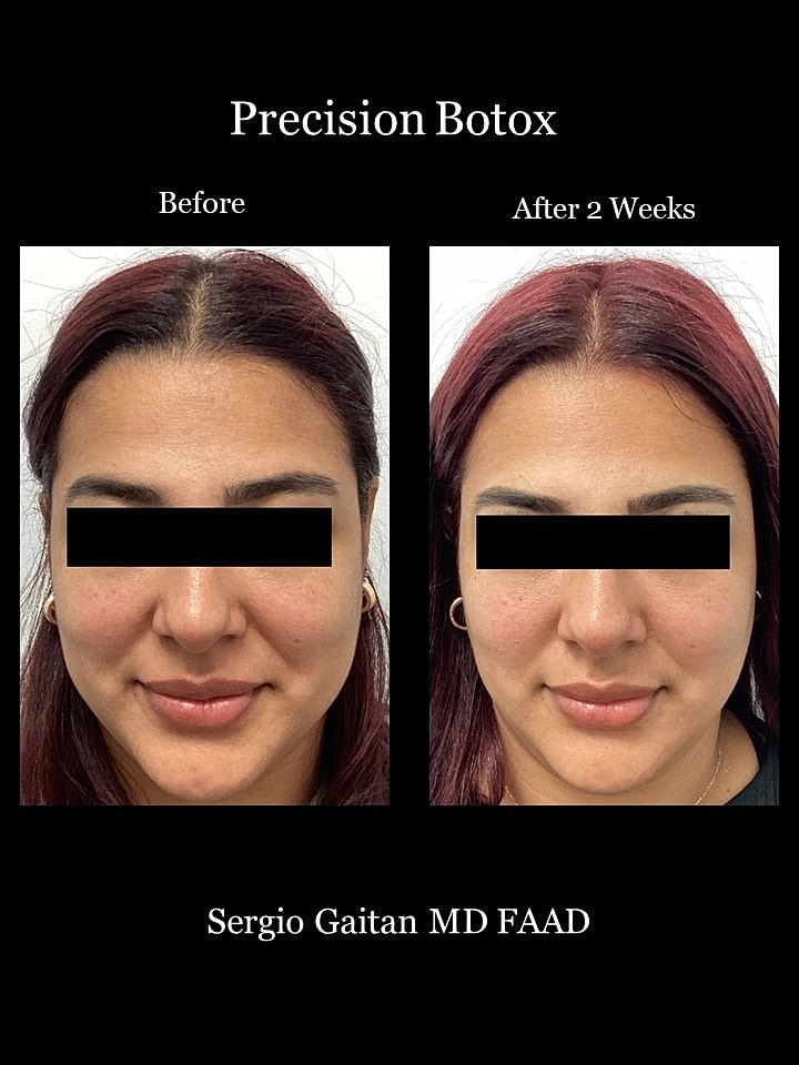 Botox Before & After