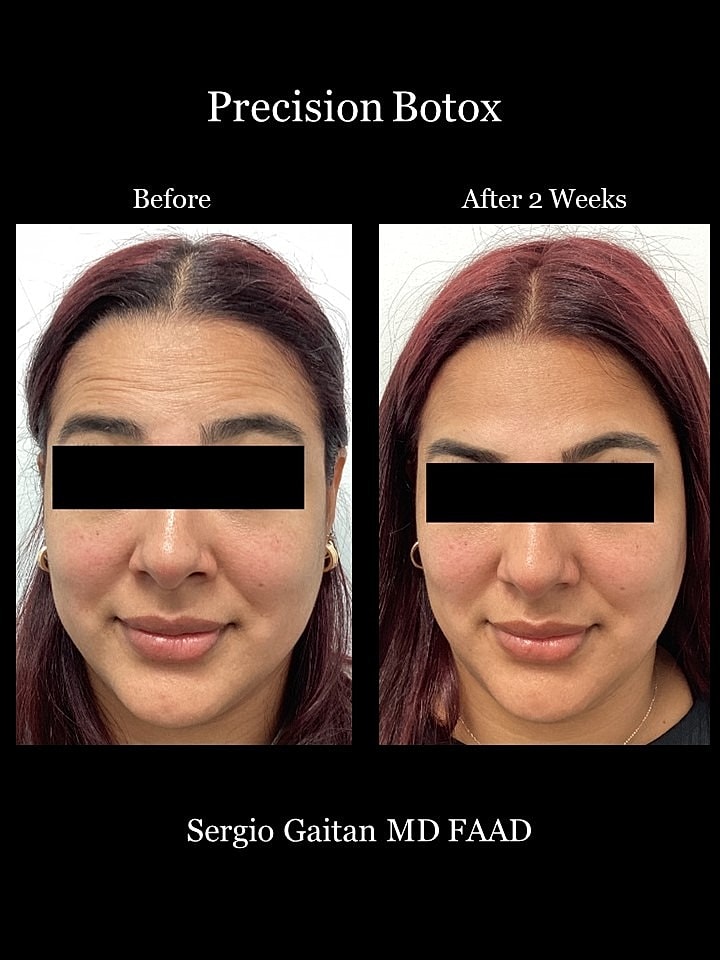 Botox Before & After
