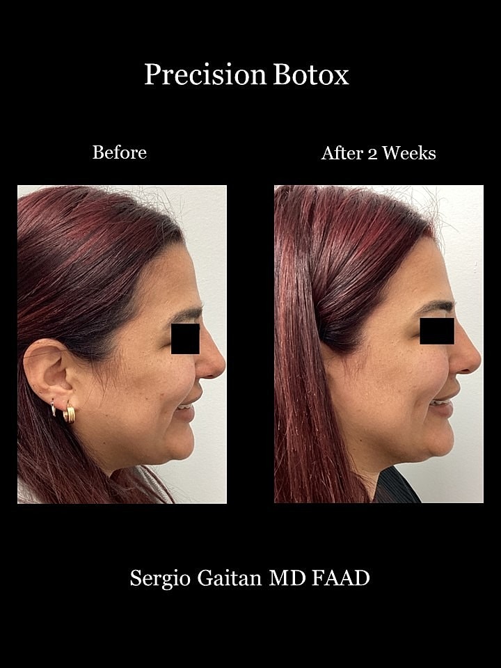 Botox Before & After