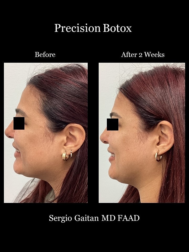 Botox Before & After