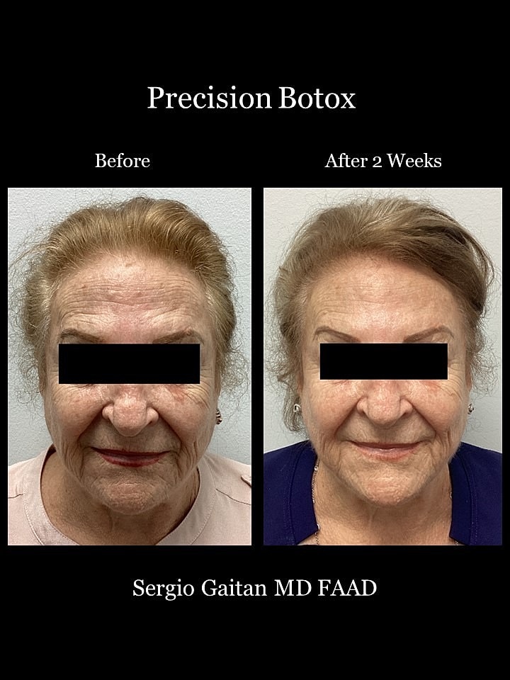 Botox Before & After