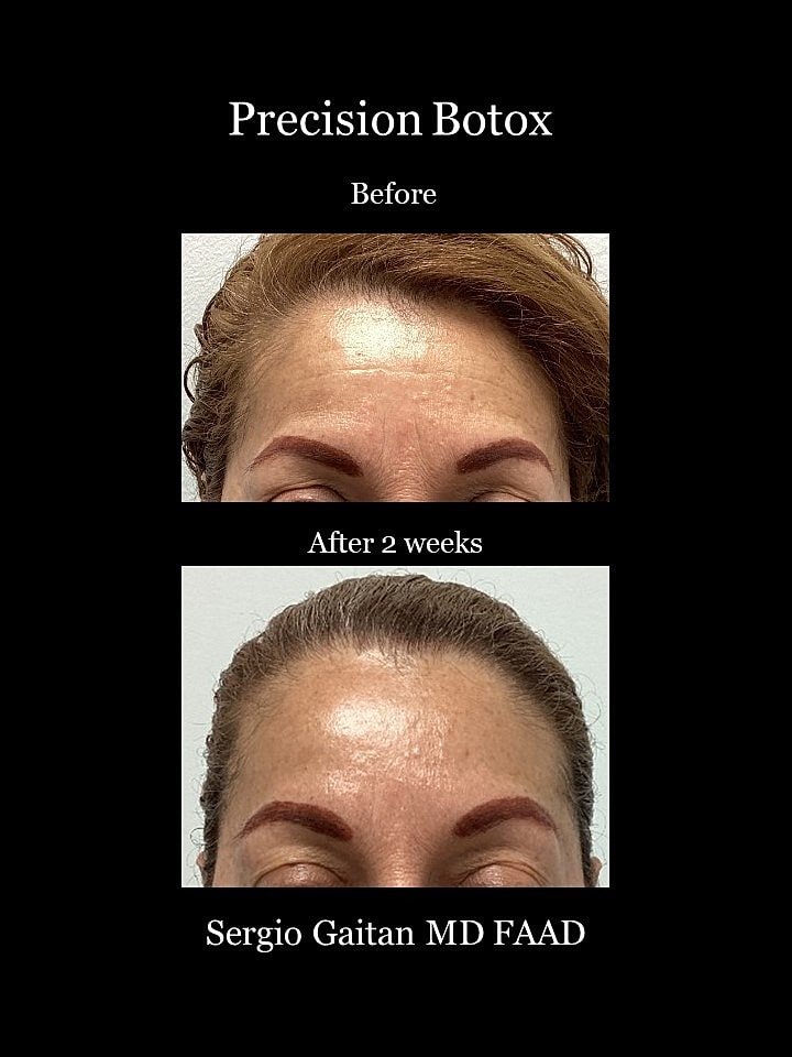 Botox Before & After