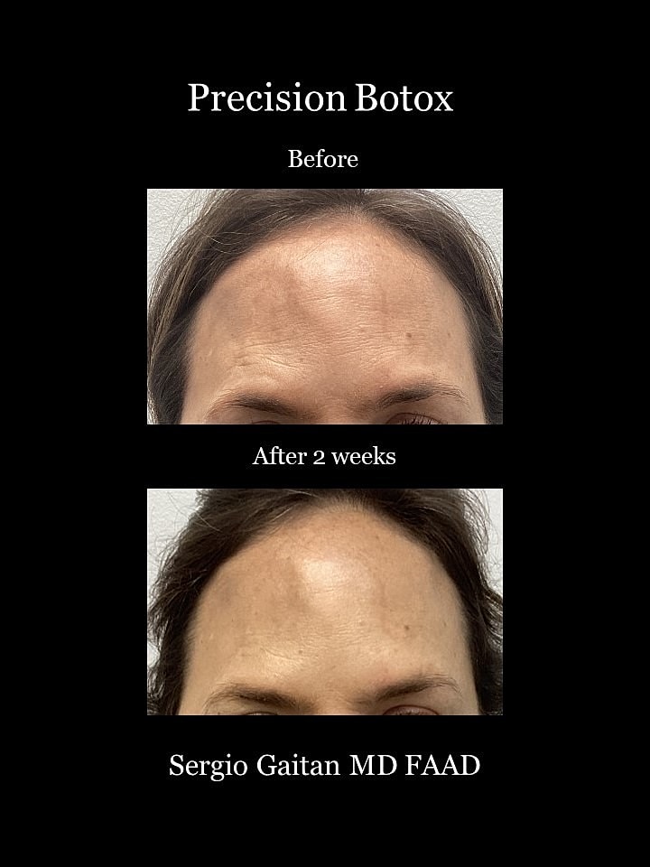 Botox Before & After