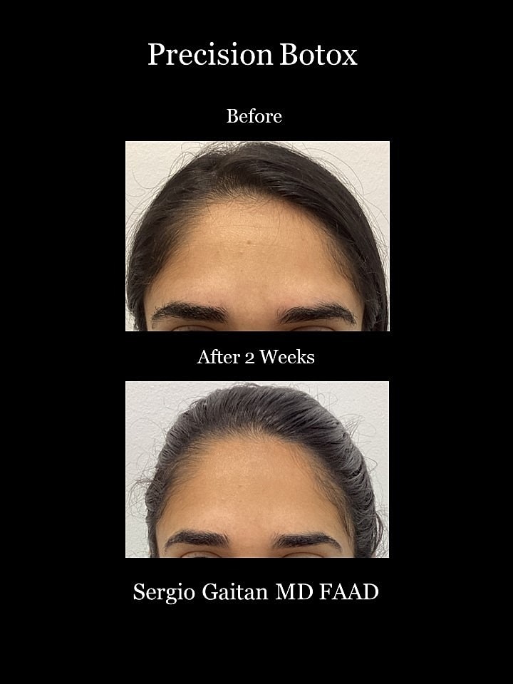 Botox Before & After