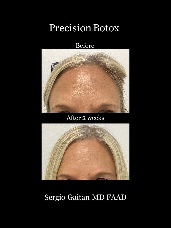 Botox Before & After
